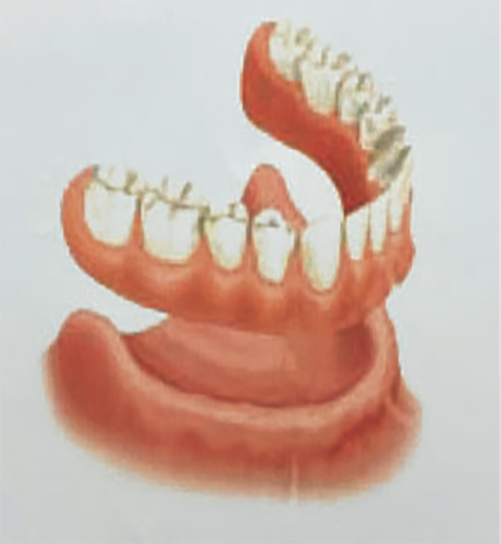 dentures above the gums